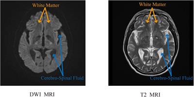 Generative adversarial networks with adaptive normalization for synthesizing T2-weighted magnetic resonance images from diffusion-weighted images